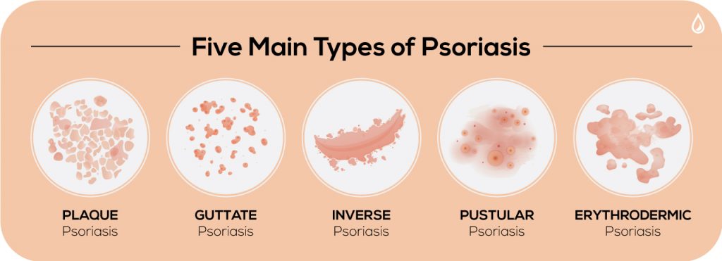5-Main-Types-of-Psoriasis-The-Dermatology-Specialists-1024x371-1.jpg